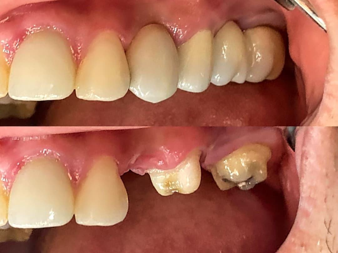 Antes y después - transformación de sonrisa