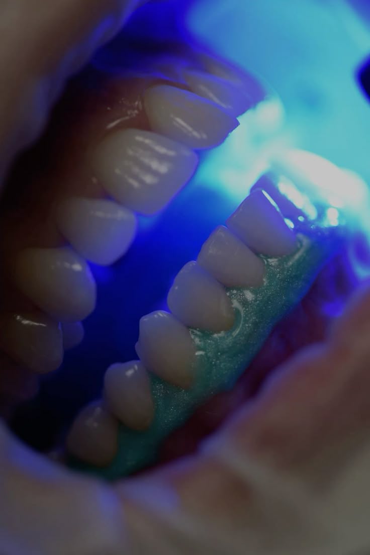 Blanqueamientos Dentales