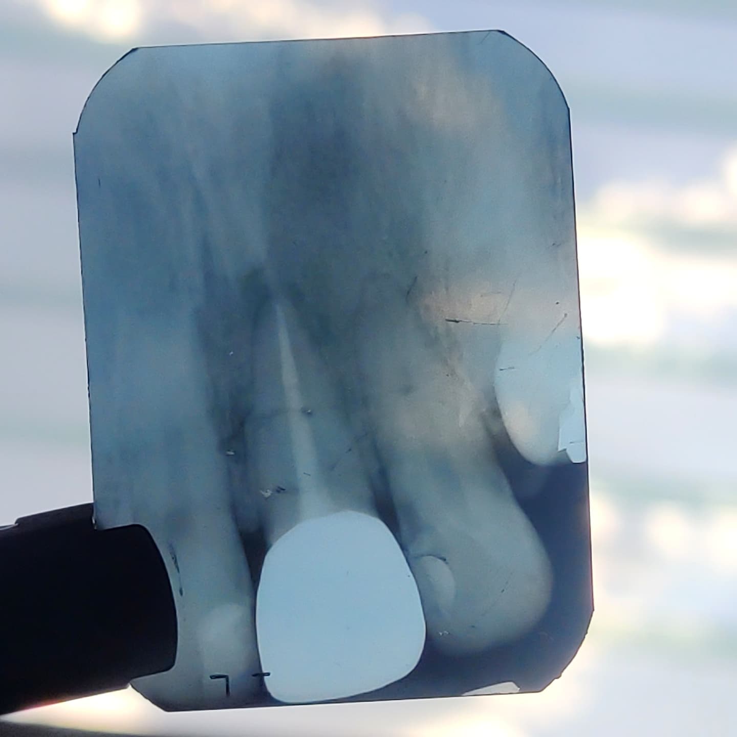 Procedimiento de endodoncia en Caracas