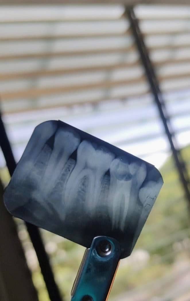 Tratamiento de conducto