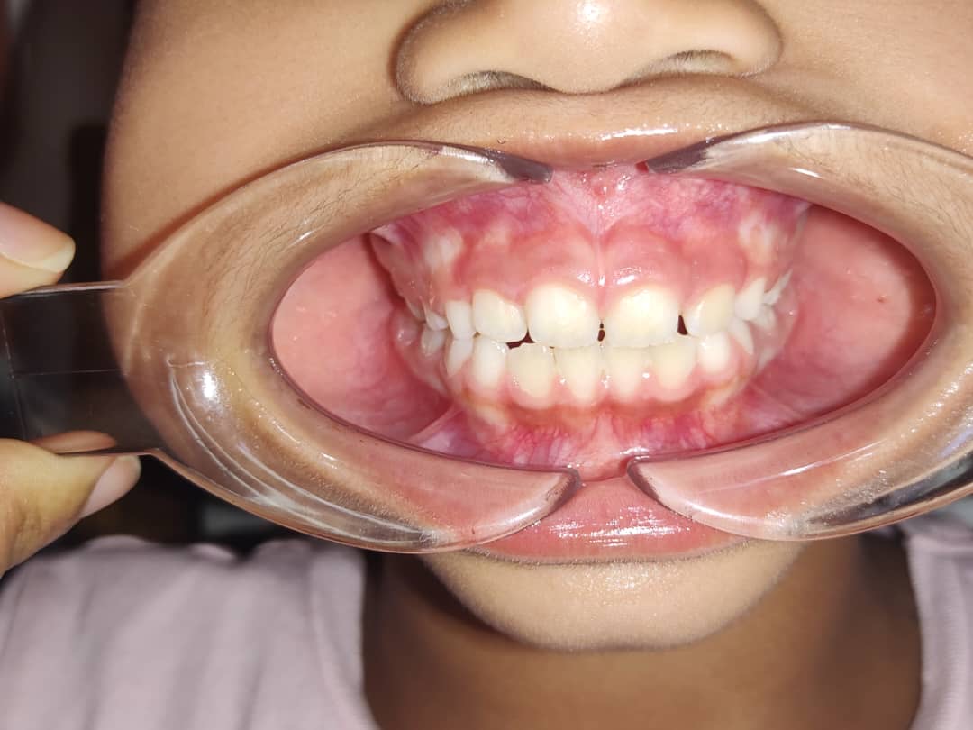 Odontopediatría - atención infantil