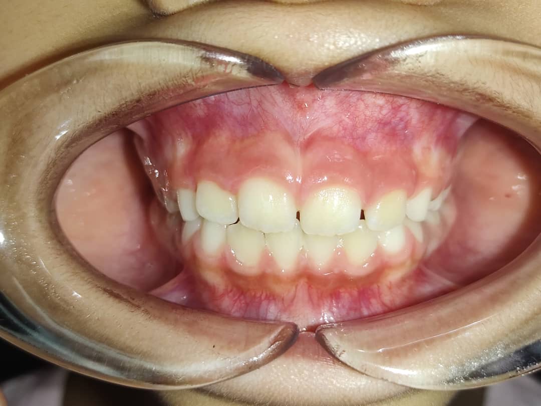 Limpieza dental infantil Caracas