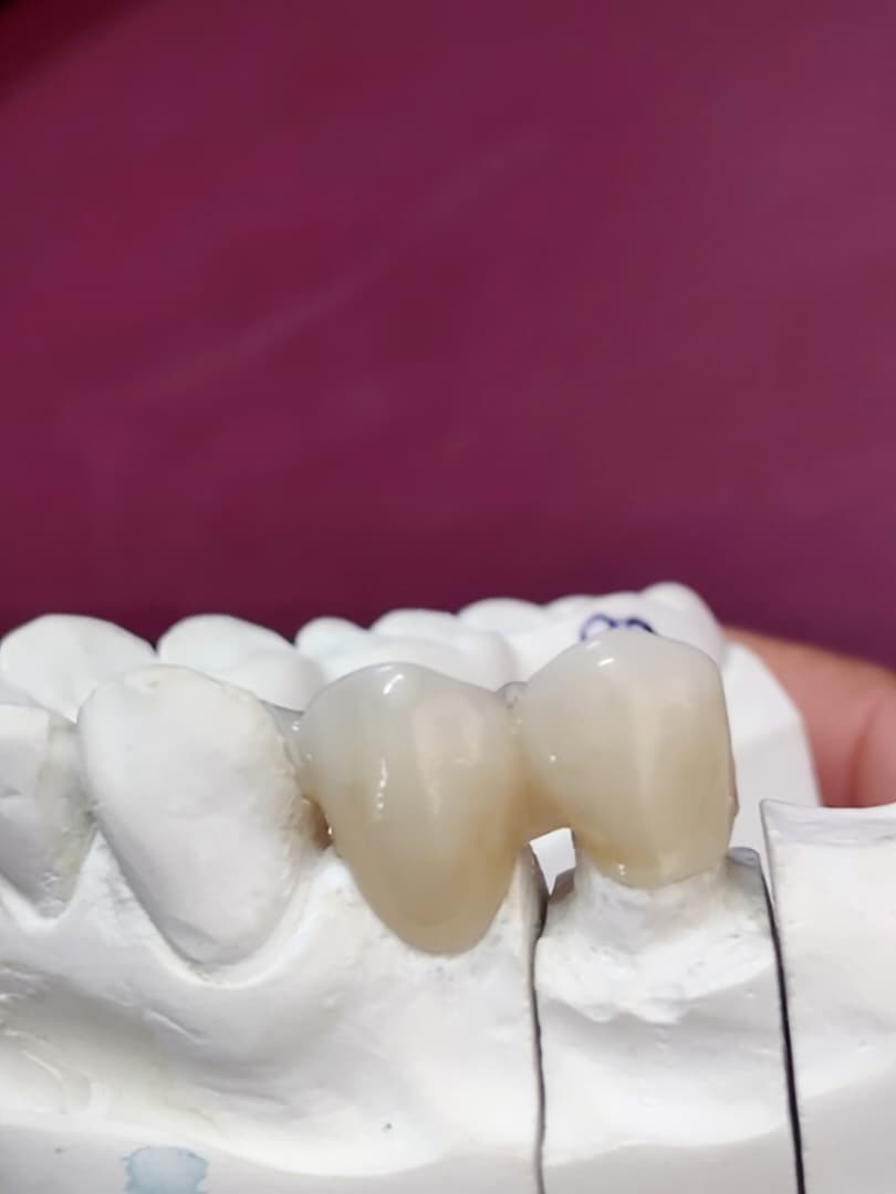 Dentadura completa Caracas