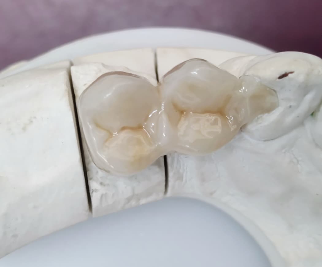 Prótesis parcial removible Caracas