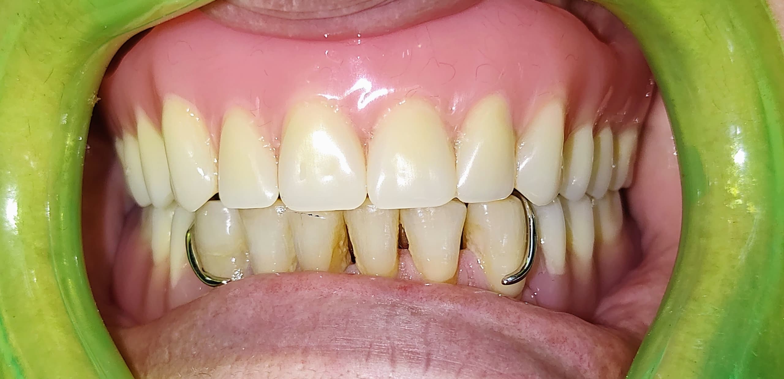 Prótesis dental - rehabilitación