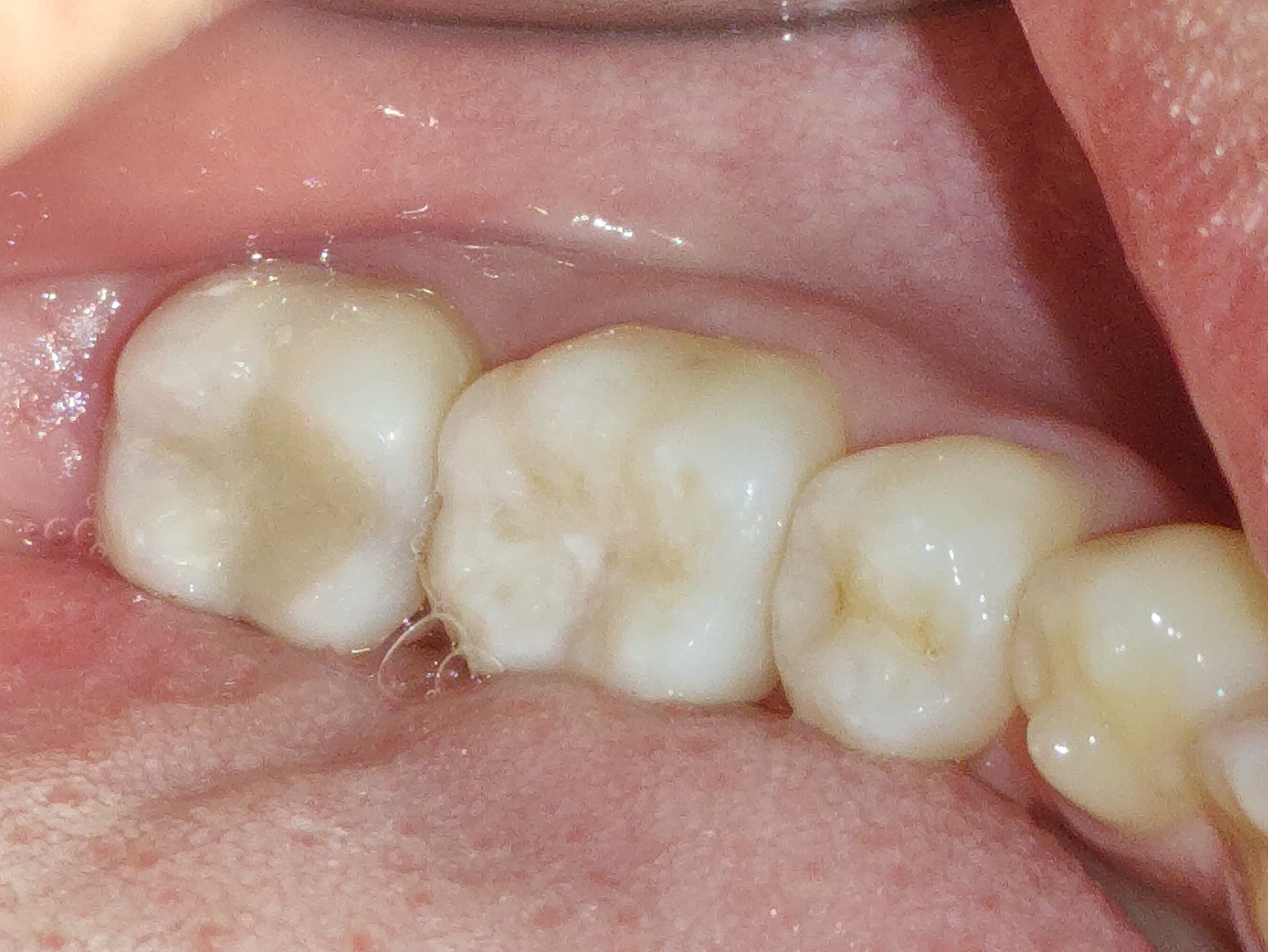 Restauración dental estética en Caracas