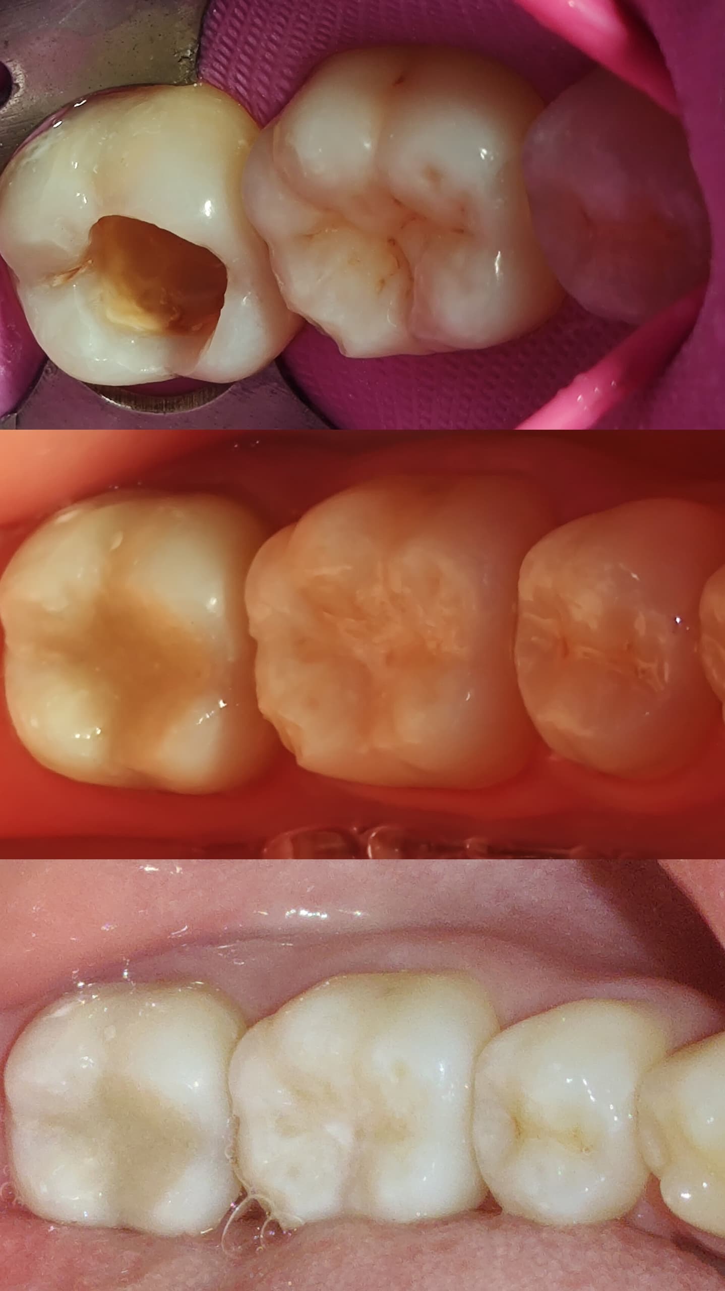 Restauración dental estética